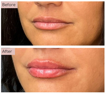 lip fillers before and afters